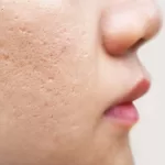 از بین بردن جای جوش صورت